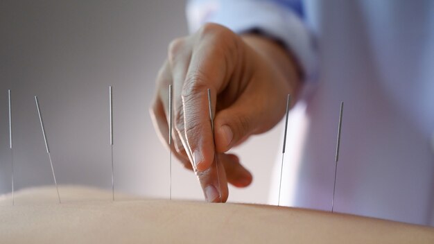 acupuntura